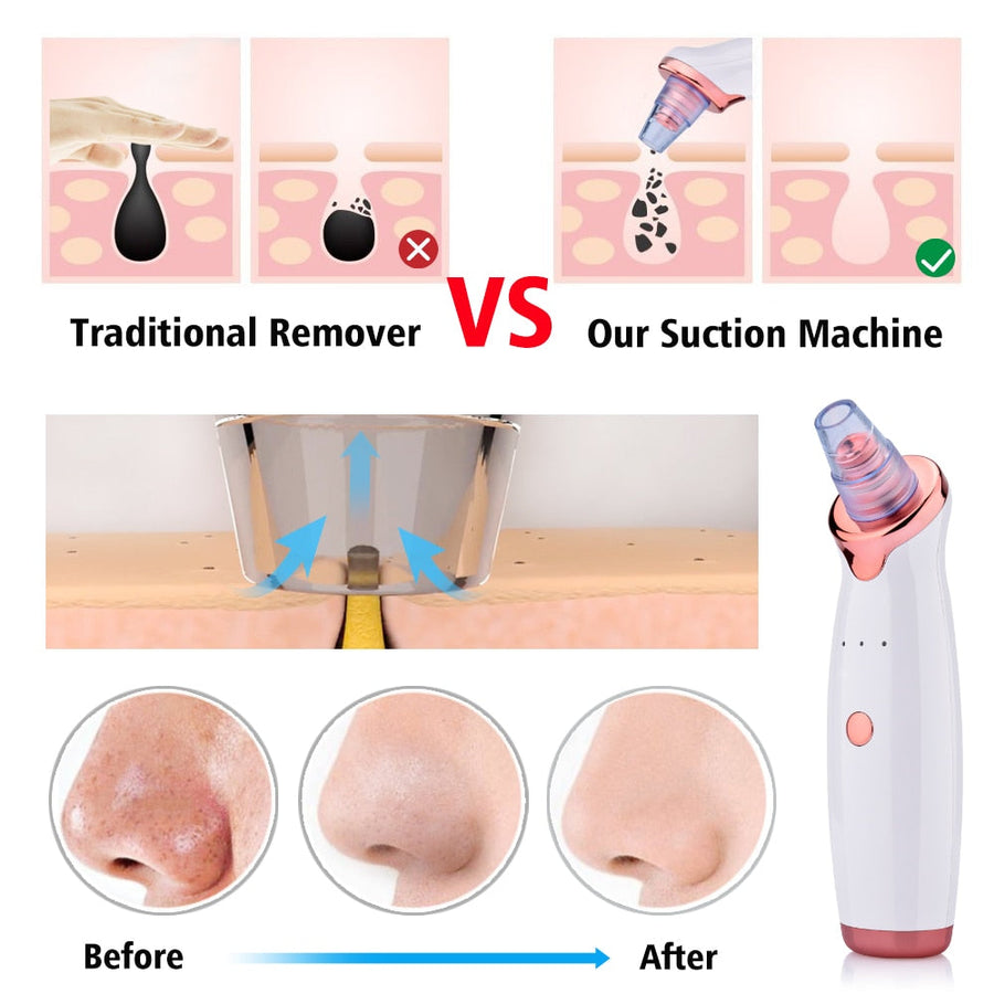 Pore Cleaner Nose Blackhead Remover  Acne Pimple Removal